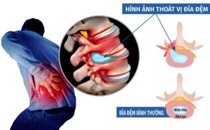 Thoát vị đĩa đệm có chữa được không?