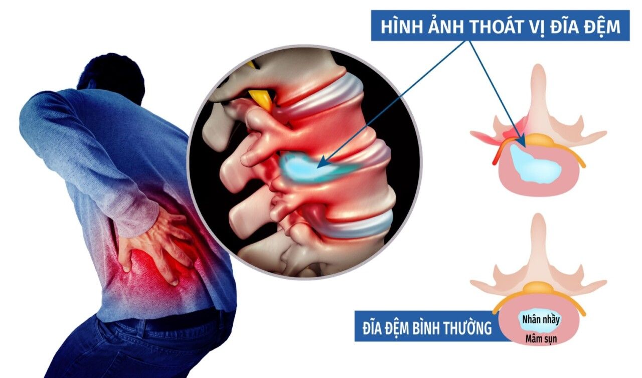 Đau nhức là triệu chứng điển hình của thoát vị đĩa đệm