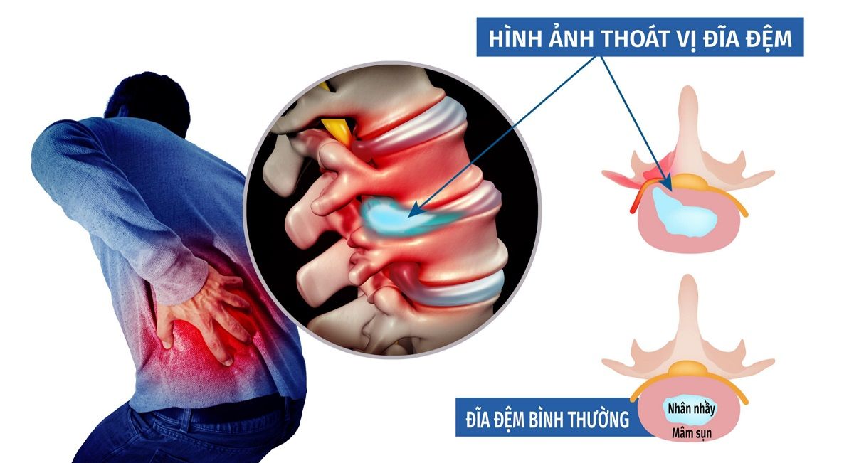 Thoát vị đĩa đệm là tình trạng nhân nhầy đĩa đệm thoát ra khỏi vị trí của nó qua các vết rách của bao xơ đĩa đệm