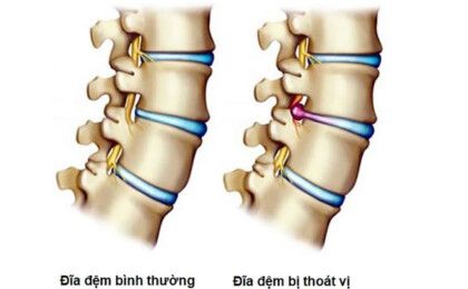 Thoát vị đĩa đệm là gì ? một số thông tin cần lưu ý