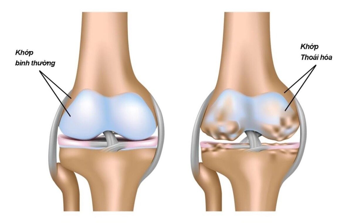 Thoái hóa khớp là gì? Thoái hóa khớp là một trong những căn bệnh mãn tính xảy ra chủ yếu ở người cao tuổi