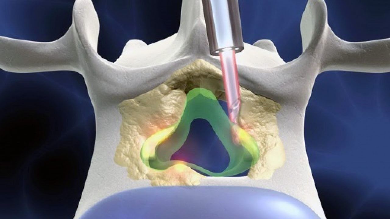 Chữa thoát vị đĩa đệm bằng laser