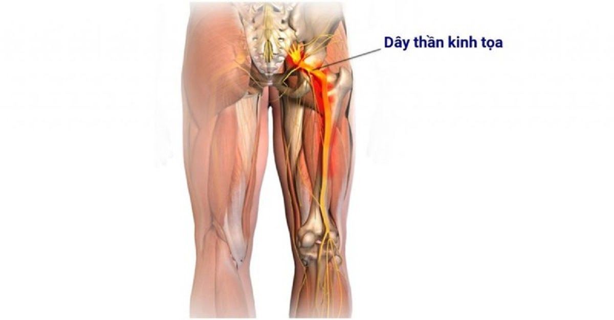 Đau dây thần kinh tọa là biến chứng của bệnh đau gai cột sống lưng