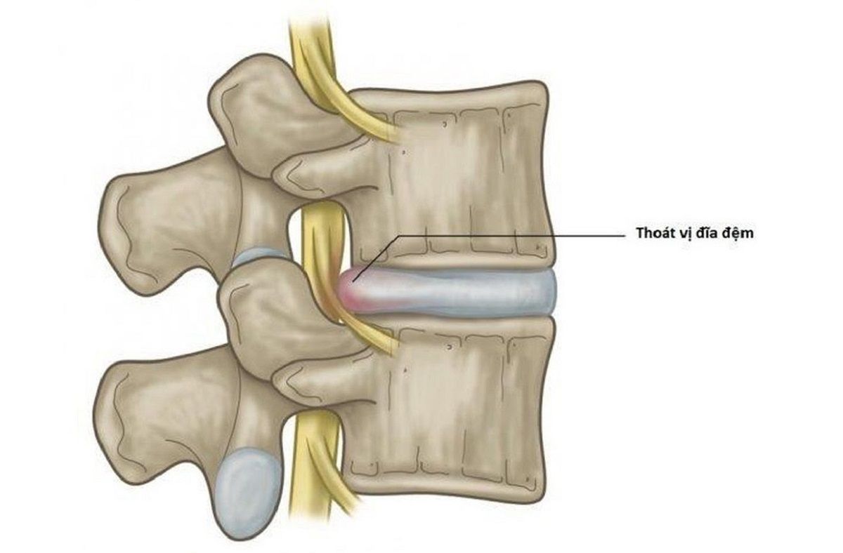 Nhiều người nhầm lẫn tình trạng đau nhức do thoát vị đĩa đệm với một số căn bệnh khác