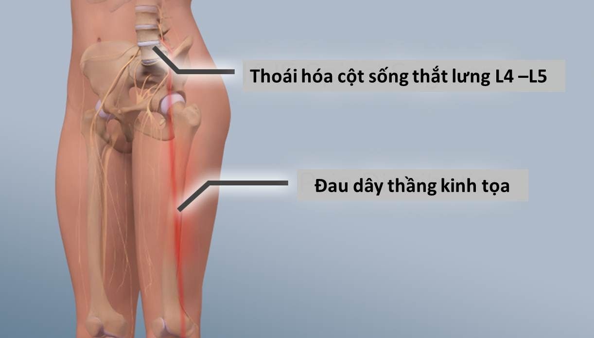 Thoái hóa cột sống thắt lưng L4 L5