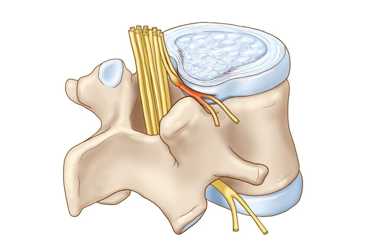 Thoái hóa đốt sống cổ chèn dây thần kinh là một dạng biểu hiện của bệnh thoái hóa cột sống ở cổ