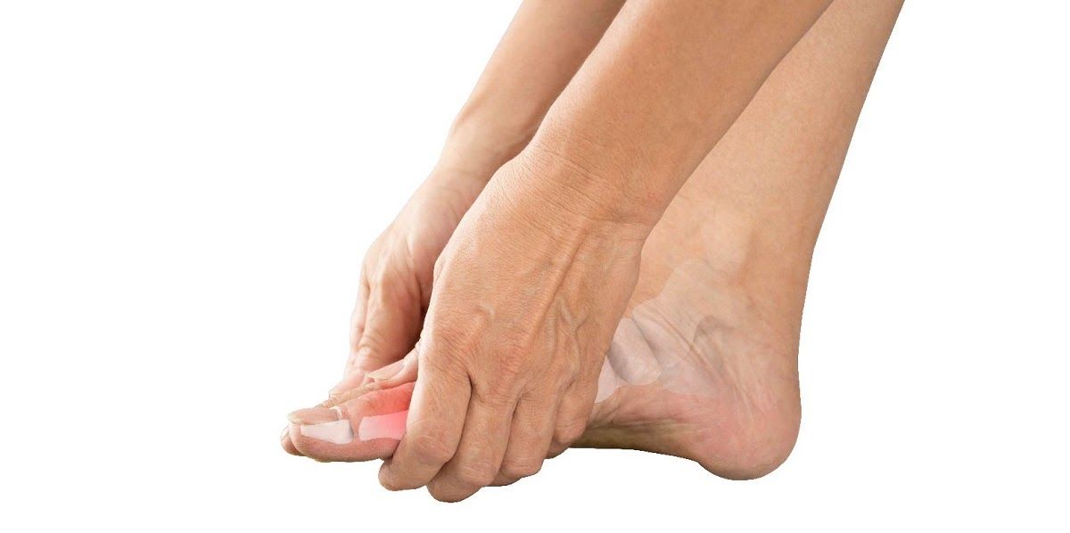 Gout là một bệnh của thoái hóa xương khớp