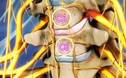 Những điều cần biết về thoát vị đĩa đệm cột sống cổ C5C6