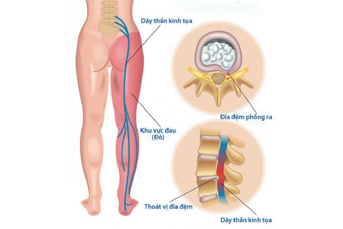 Thoát vị đĩa đệm là một trong những bệnh xương khớp nguy hiểm nhất hiện nay