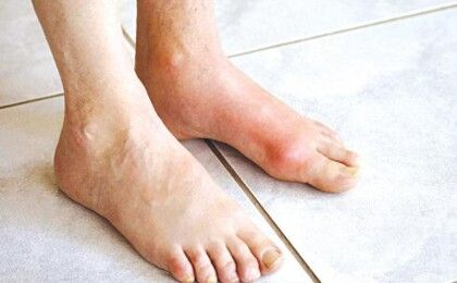 Hướng dẫn nhận biết triệu chứng của bệnh gout phổ biến