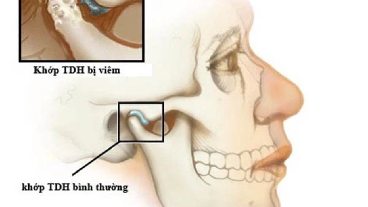 Có nhiều nguyên nhân gây ra viêm khớp hàm thái dương