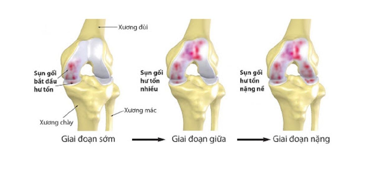 Các giai đoạn thoái hóa khớp gối