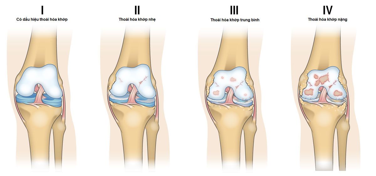 Các giai đoạn của bệnh thoái hóa khớp gối