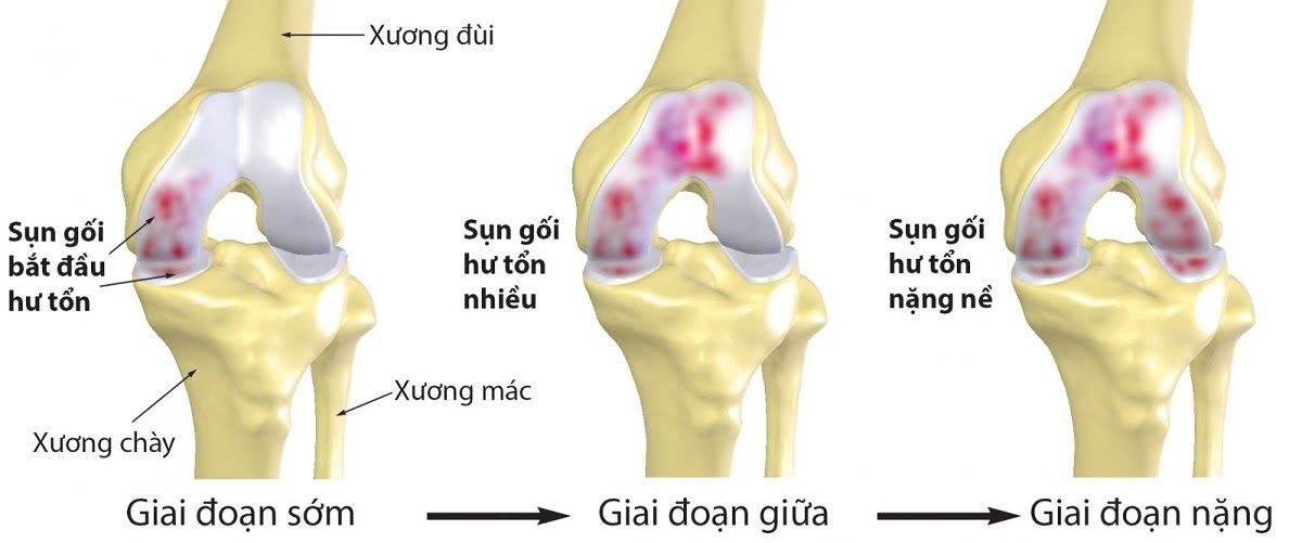 Các giai đoạn thoái hóa khớp gối