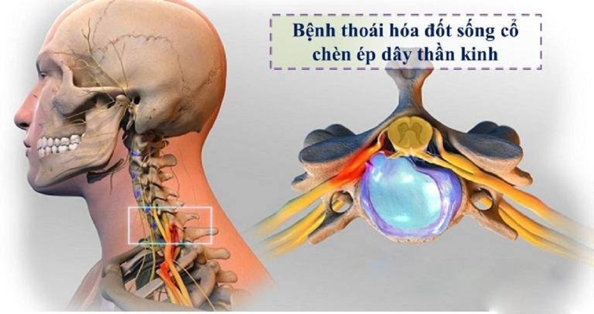 Thoái hóa đốt sống cổ chèn ép dây thần kinh gây ra nhiều biến chứng nguy hiểm