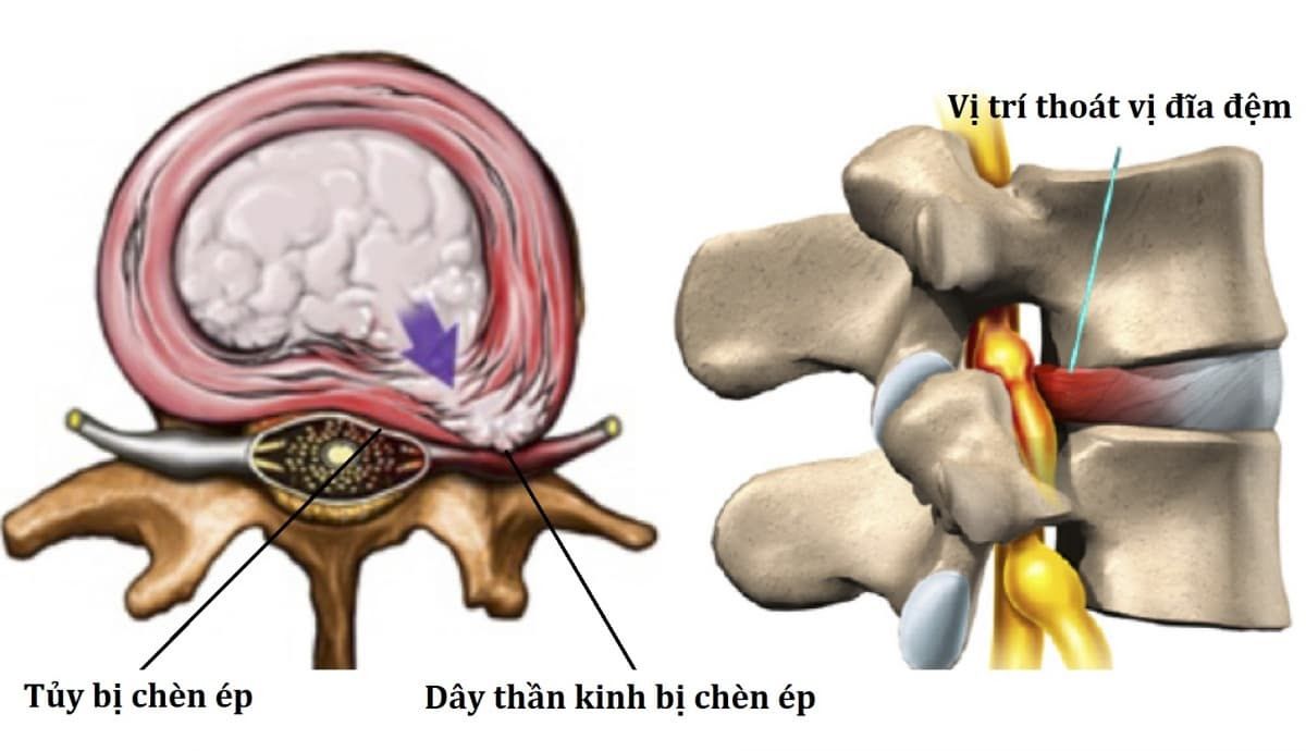 Hình ảnh thoát vị đĩa đệm