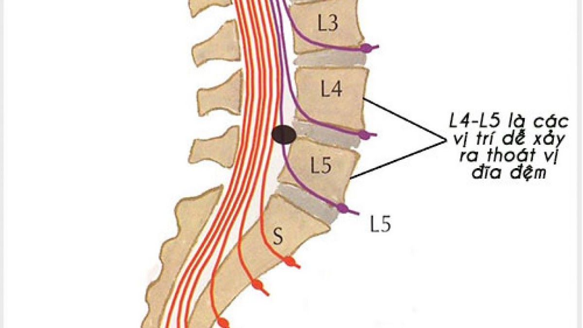 Thoát vị đĩa đệm L4 L5