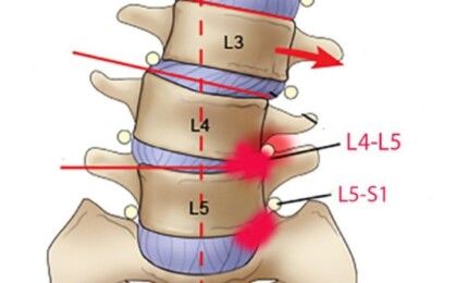 Thoát vị đĩa đệm L5 S1 và những thông tin cần biết