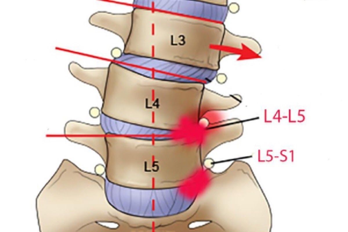 Thoát vị đĩa đệm L5 S1