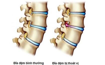 Thoát vị đĩa đệm: nguyên nhân và cách nhận biết triệu chứng