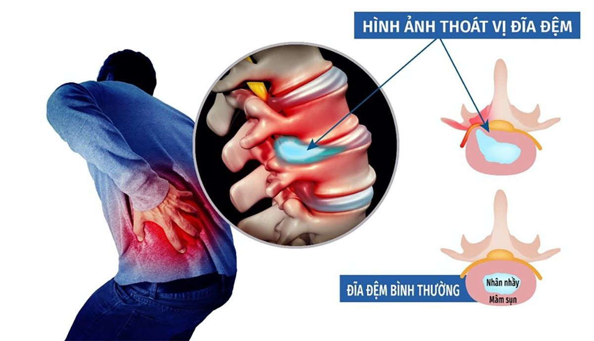 Triệu chứng thoát vị đĩa đệm ở người trẻ tuổi gây ra các cơn đau kéo dài vùng cổ, vùng thắt lưng