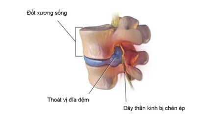 Điều trị bệnh thoát vị đĩa đệm