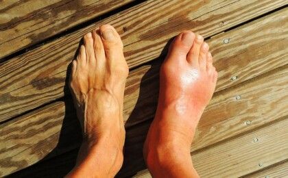 Triệu chứng của bệnh gout và phương pháp giảm đau hiệu quả