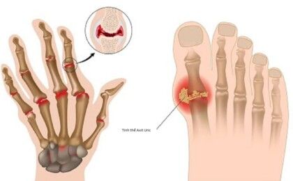 Triệu chứng của bệnh gout là gì? Nguyên nhân và cách điều trị