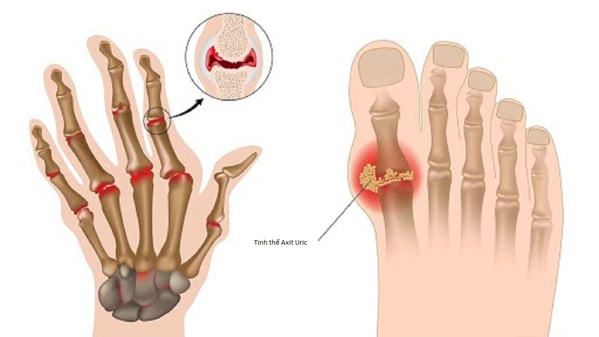 Bệnh gout là tình trạng các tinh thể axit uric lắng đọng trong khớp 