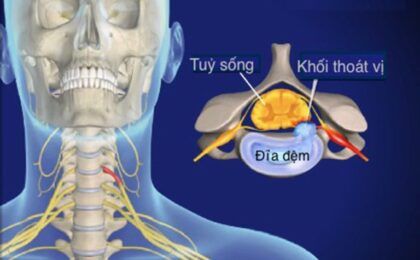 Thoái hóa đốt sống cổ – Những biểu hiện cần lưu ý