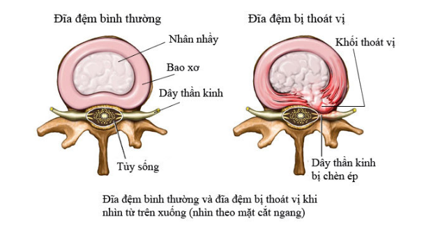 Cấu tạo của đĩa đệm cột sống