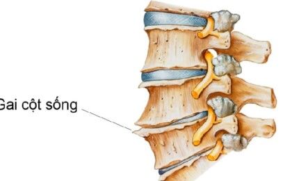 Tìm hiểu về gai cột sống cổ và cách chữa trị