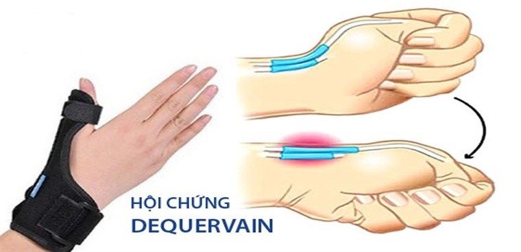 Hội chứng De Quervain