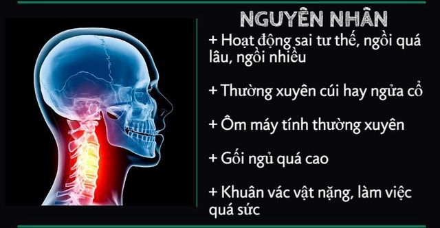 Nguyên nhân gây thoái hóa đốt sống cổ