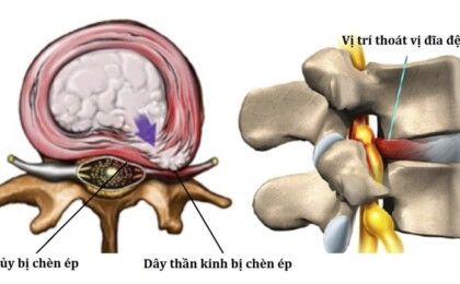 Thoát vị đĩa đệm cột sống cổ cần điều trị sớm