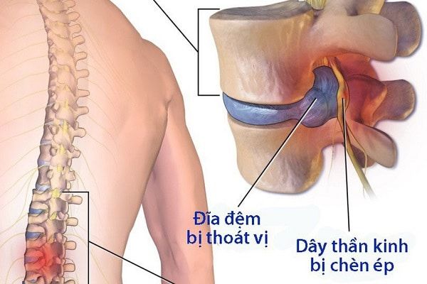 Thoát vị đĩa đệm cột sống thắt lưng là bệnh gì