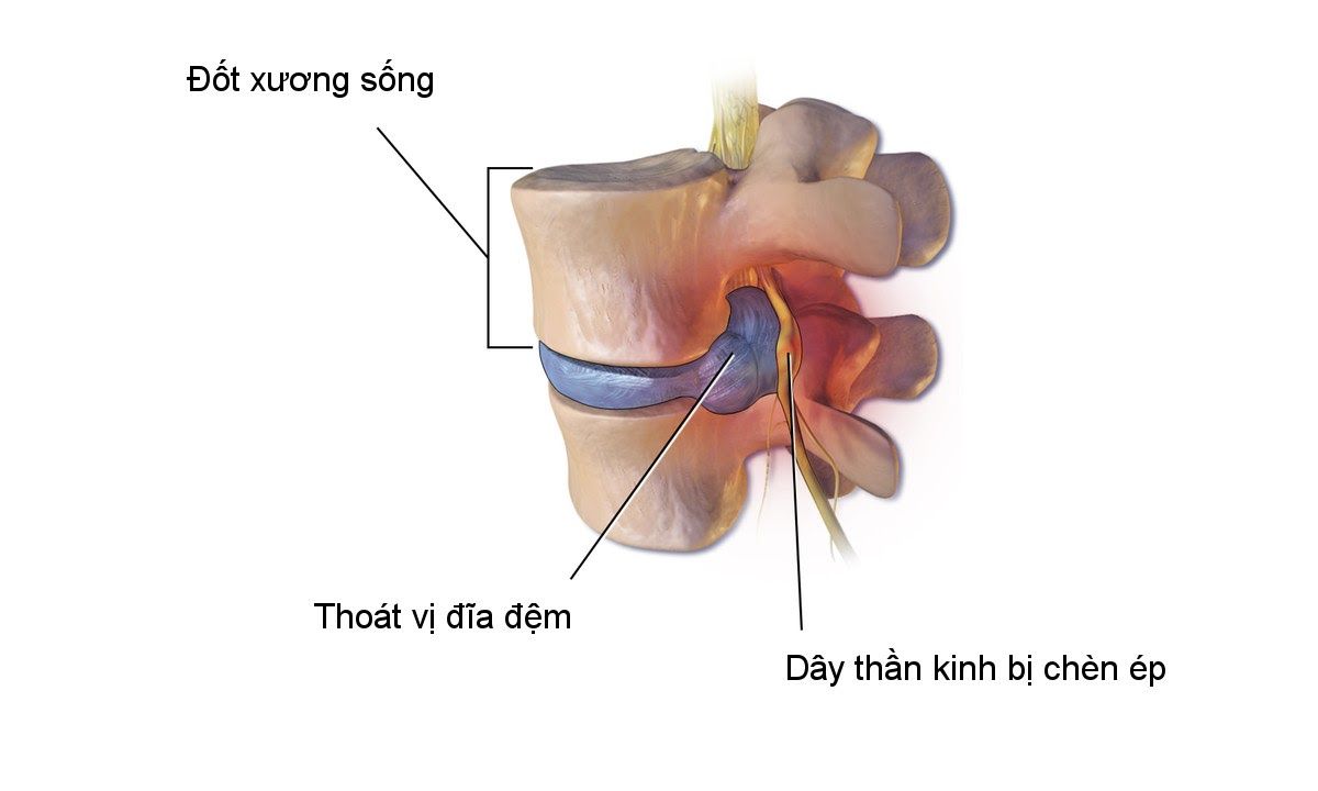 Hình ảnh thoát vị đĩa đệm