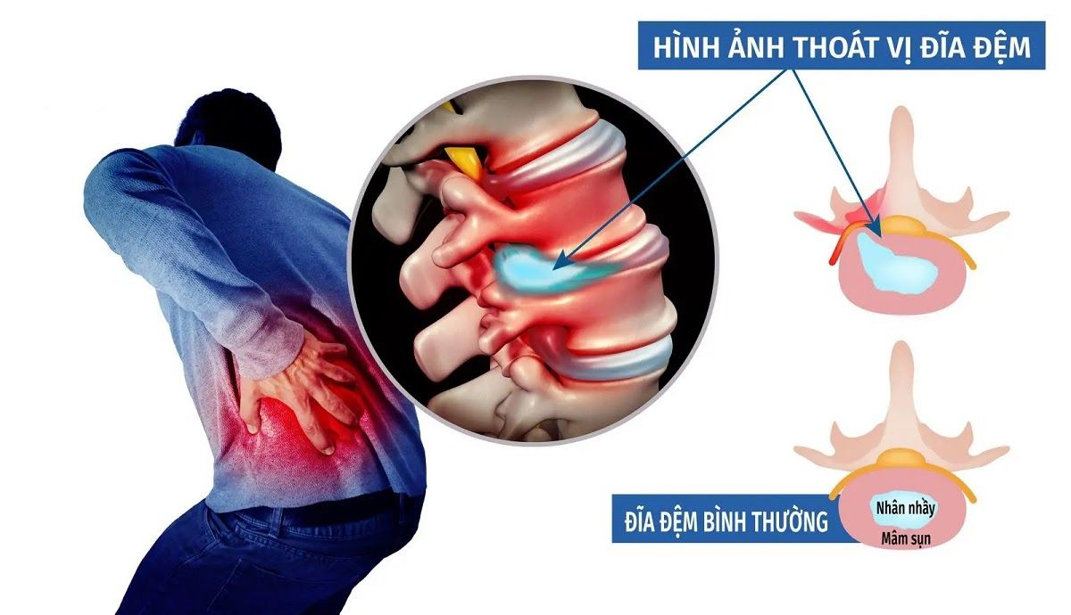 Thoát vị đĩa đệm không được điều trị kịp thời, để đến giai đoạn cuối thì nguy cơ bị tàn phế suốt đời rất cao.