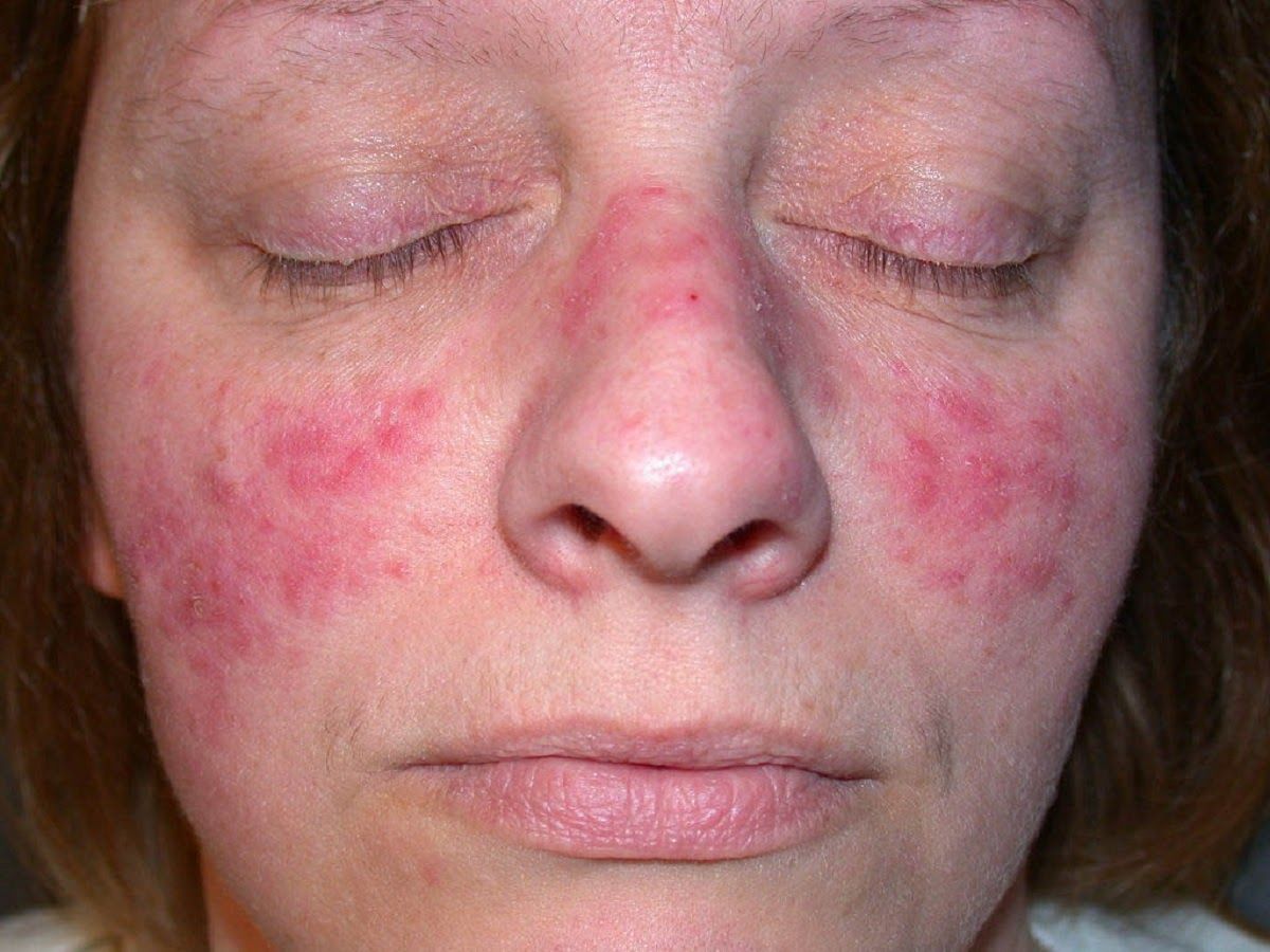 Biến chứng của Lupus ban đỏ gây viêm đa khớp dạng thấp