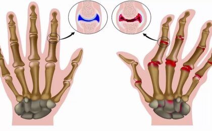 Tìm hiểu: Bệnh viêm khớp dạng thấp có di truyền không?