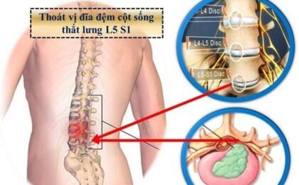 Thoát vị đĩa đệm cột sống thắt lưng là gì? có chữa được không?