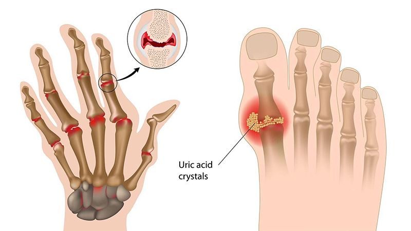 Sưng ngón chân cái ở bệnh gout