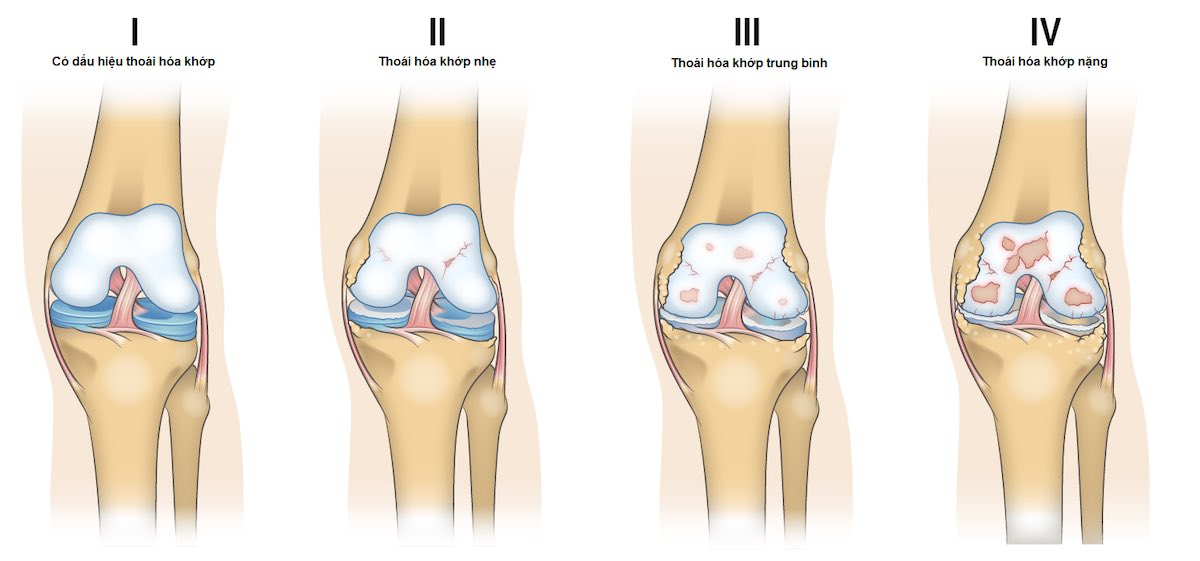 Hình minh họa các mức độ thoái hóa khớp