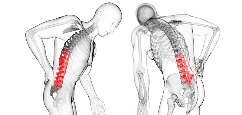 Bạn có biết tại sao bị thoát vị đĩa đệm không?