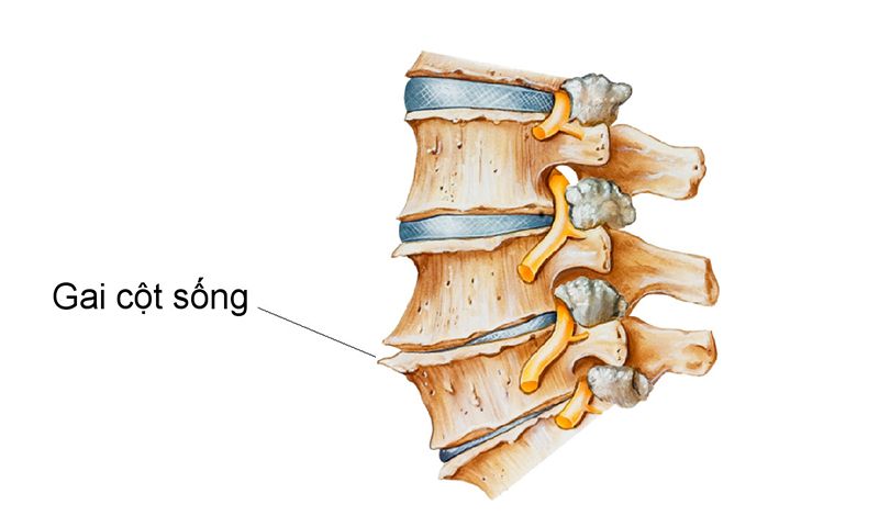 Cột sống xuất hiện gai xương