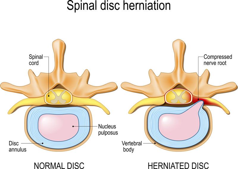 Bệnh thoát vị đĩa đệm cột sống thắt lưng