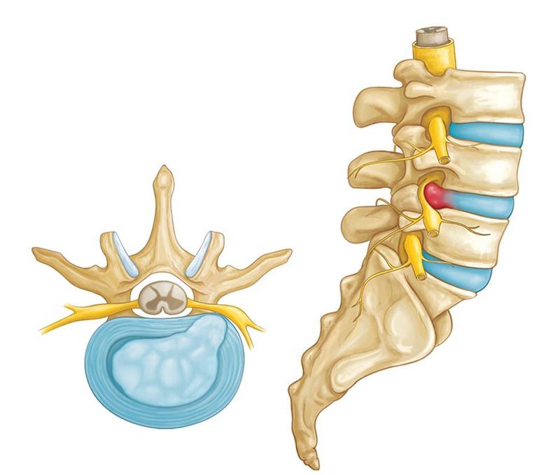 Minh họa đĩa đệm bị thoát vị