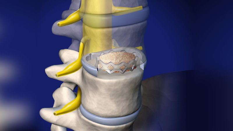 Bệnh thoát vị đĩa đệm và cách điều trị bằng đĩa đệm nhân tạo