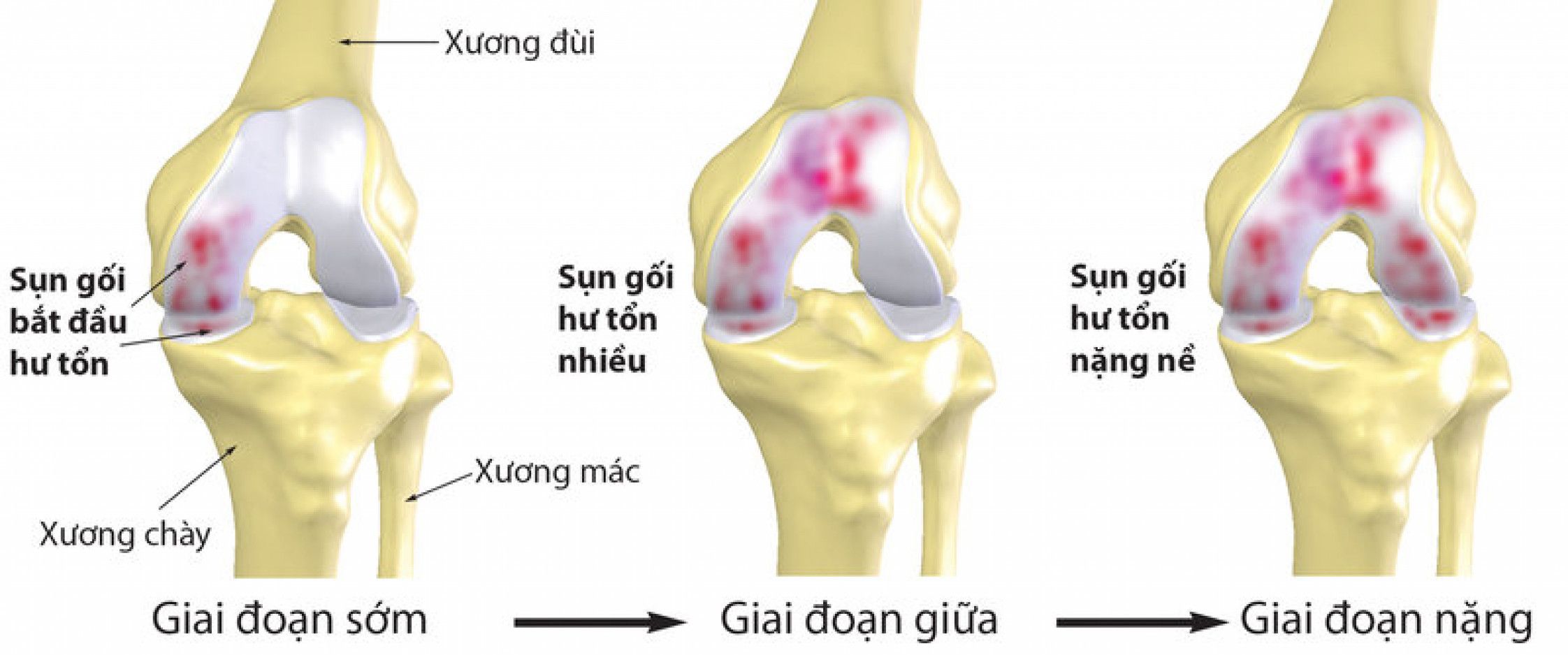 Quá trình thoái hóa của sụn khớp gối