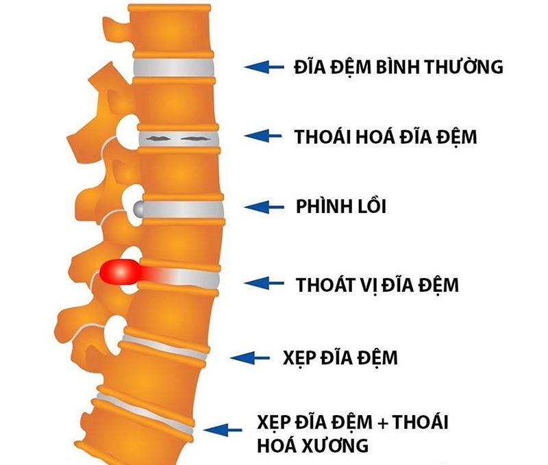 Gai cột sống là tình trạng các mẫu xương mọc dài ra ma sát với các bộ phận xung quanh